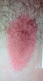 rash2