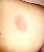 rash3